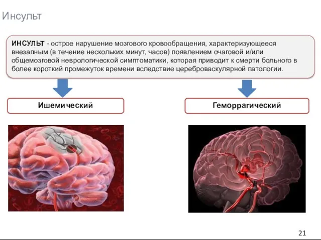 Инсульт ИНСУЛЬТ - острое нарушение мозгового кровообращения, характеризующееся внезапным (в течение нескольких