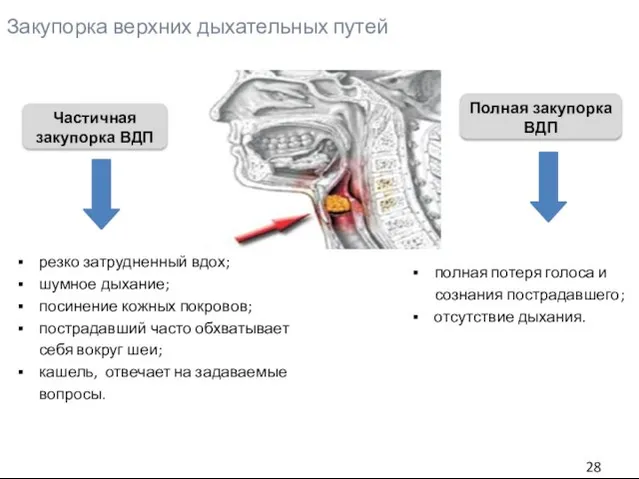 Закупорка верхних дыхательных путей Частичная закупорка ВДП Полная закупорка ВДП резко затрудненный