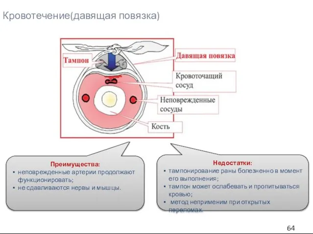 Кровотечение(давящая повязка) Преимущества: неповрежденные артерии продолжают функционировать; не сдавливаются нервы и мышцы.