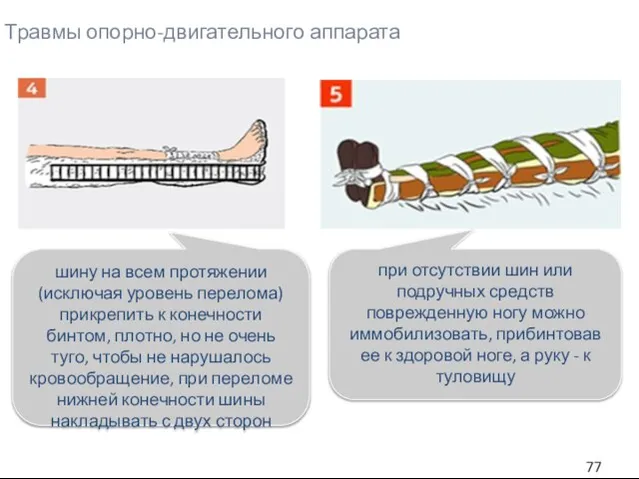 Травмы опорно-двигательного аппарата шину на всем протяжении (исключая уровень перелома) прикрепить к