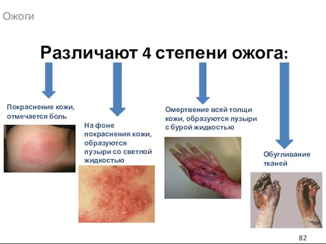 Ожоги Различают 4 степени ожога: Покраснение кожи, отмечается боль Обугливание тканей На