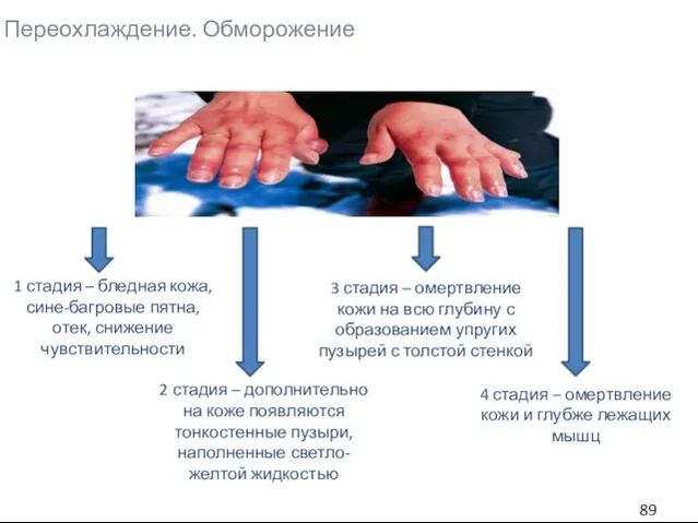 Переохлаждение. Обморожение 1 стадия – бледная кожа, сине-багровые пятна, отек, снижение чувствительности