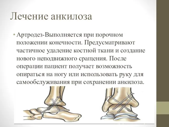 Лечение анкилоза Артродез-Выполняется при порочном положении конечности. Предусматривают частичное удаление костной ткани