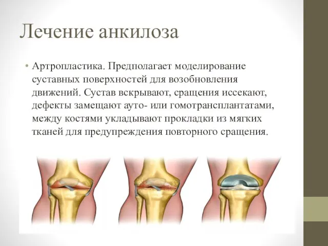 Лечение анкилоза Артропластика. Предполагает моделирование суставных поверхностей для возобновления движений. Сустав вскрывают,