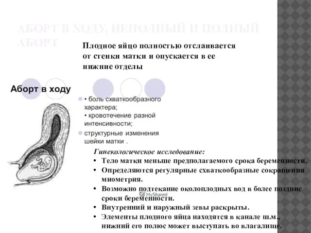 АБОРТ В ХОДУ, НЕПОЛНЫЙ И ПОЛНЫЙ АБОРТ Плодное яйцо полностью отслаивается от