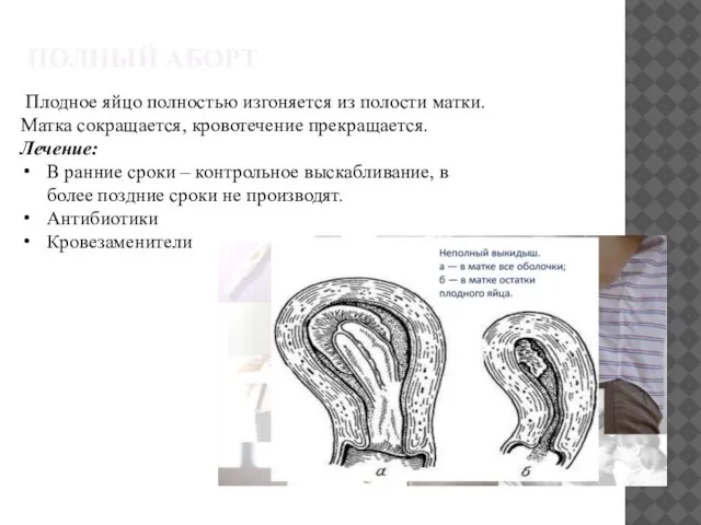 ПОЛНЫЙ АБОРТ Плодное яйцо полностью изгоняется из полости матки. Матка сокращается, кровотечение