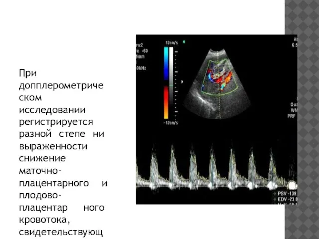 При допплерометрическом исследовании регистрируется разной степе­ ни выраженности снижение маточно-плацентарного и плодово-плацентар­