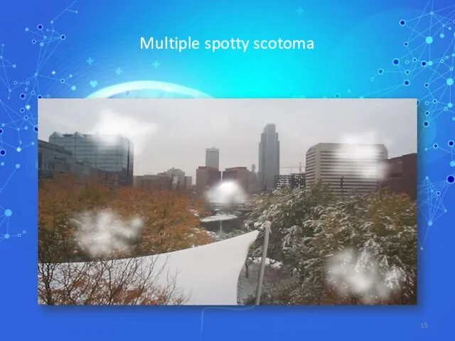 Multiple spotty scotoma