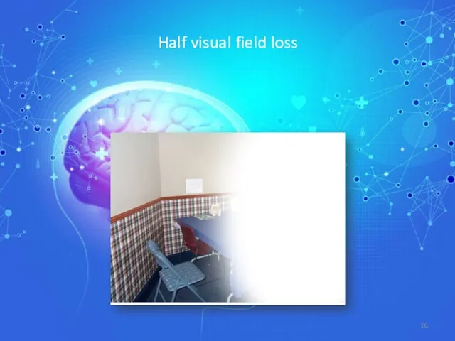 Half visual field loss