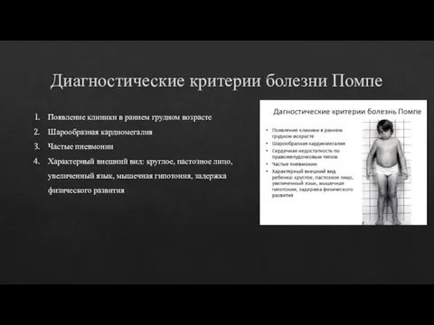 Диагностические критерии болезни Помпе Появление клиники в раннем грудном возрасте Шарообразная кардиомегалия