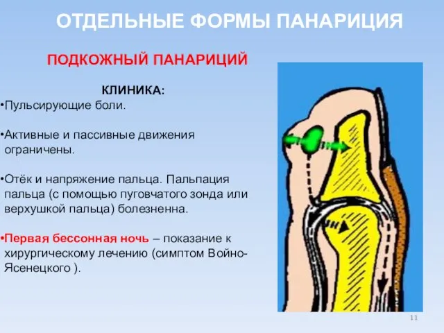 ОТДЕЛЬНЫЕ ФОРМЫ ПАНАРИЦИЯ КЛИНИКА: Пульсирующие боли. Активные и пассивные движения ограничены. Отёк