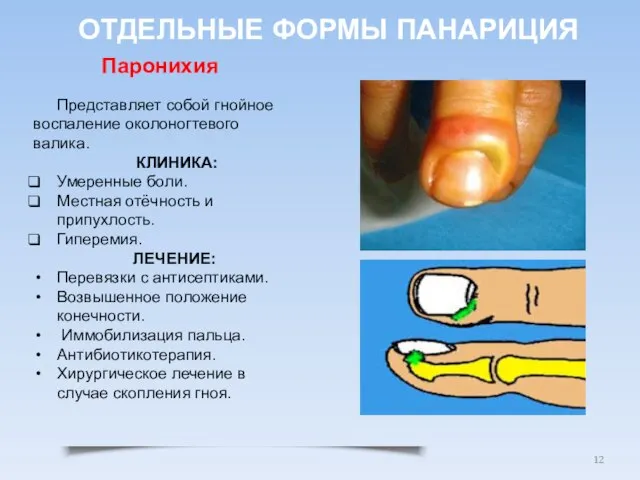 Представляет собой гнойное воспаление околоногтевого валика. КЛИНИКА: Умеренные боли. Местная отёчность и