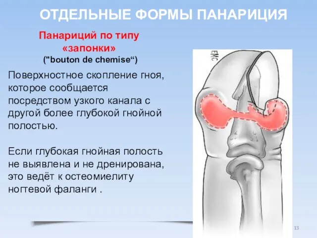 Поверхностное скопление гноя, которое сообщается посредством узкого канала с другой более глубокой