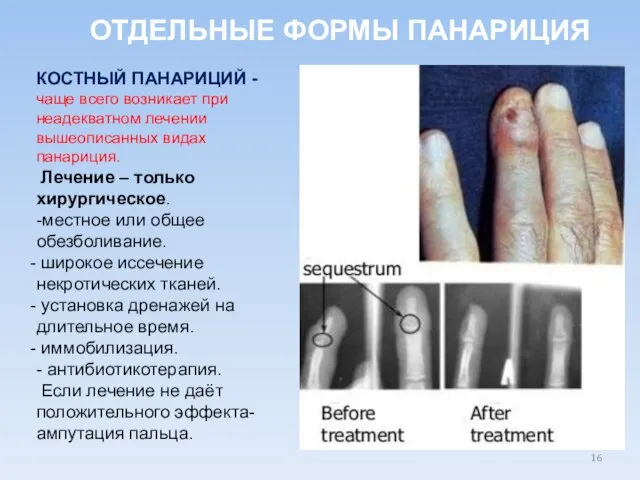 ОТДЕЛЬНЫЕ ФОРМЫ ПАНАРИЦИЯ КОСТНЫЙ ПАНАРИЦИЙ - чаще всего возникает при неадекватном лечении