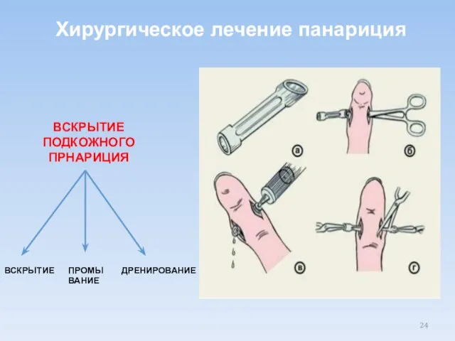 Хирургическое лечение панариция ВСКРЫТИЕ ПОДКОЖНОГО ПРНАРИЦИЯ ВСКРЫТИЕ ПРОМЫВАНИЕ ДРЕНИРОВАНИЕ