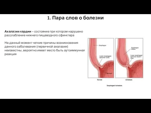 Ахалазия кардии – состояние при котором нарушено расслабление нижнего пищеводного сфинктера На