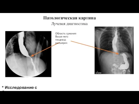 Патологическая картина Лучевая диагностика Область сужения Выше него пищевод расширен * Исследование с барием