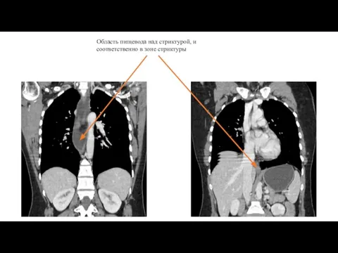 Область пищевода над стриктурой, и соответственно в зоне стриктуры