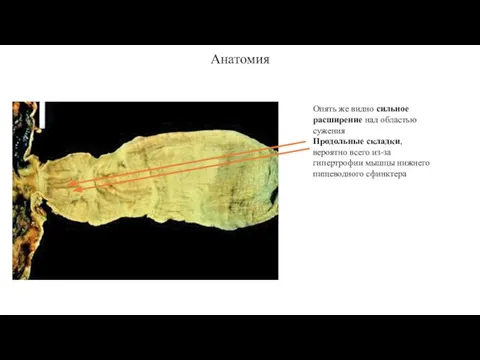 Анатомия Опять же видно сильное расширение над областью сужения Продольные складки, вероятно