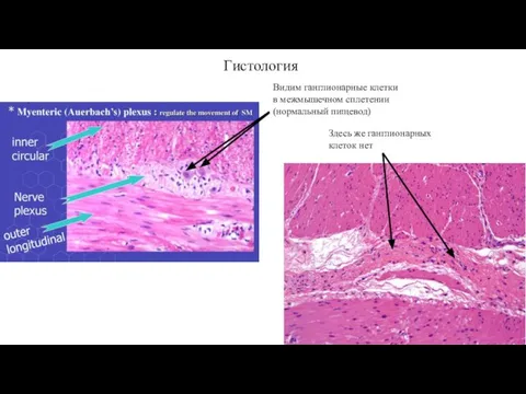 Видим ганглионарные клетки в межмышечном сплетении (нормальный пищевод) Здесь же ганглионарных клеток нет Гистология