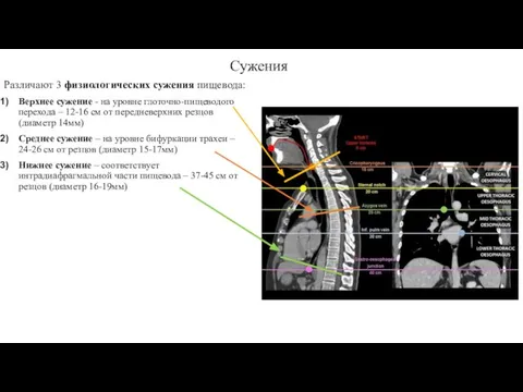 Сужения Различают 3 физиологических сужения пищевода: Верхнее сужение - на уровне глоточно-пищеводого
