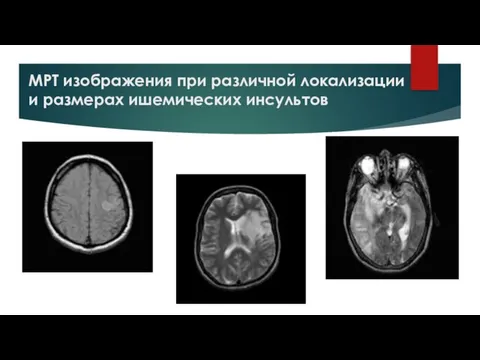 МРТ изображения при различной локализации и размерах ишемических инсультов