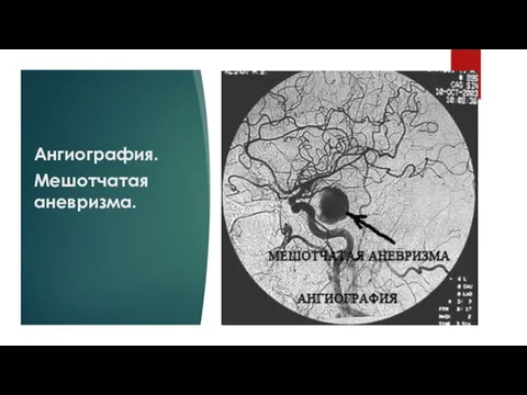 Ангиография. Мешотчатая аневризма.