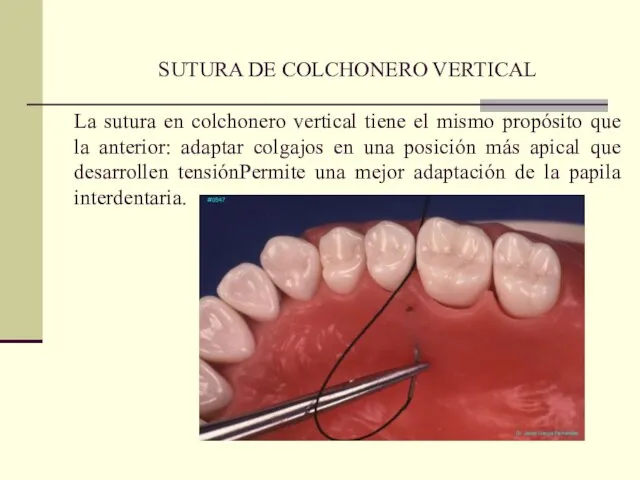 SUTURA DE COLCHONERO VERTICAL La sutura en colchonero vertical tiene el mismo