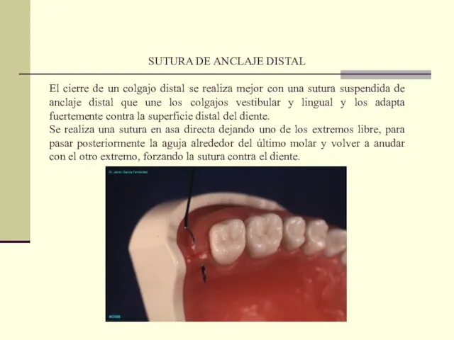 SUTURA DE ANCLAJE DISTAL El cierre de un colgajo distal se realiza