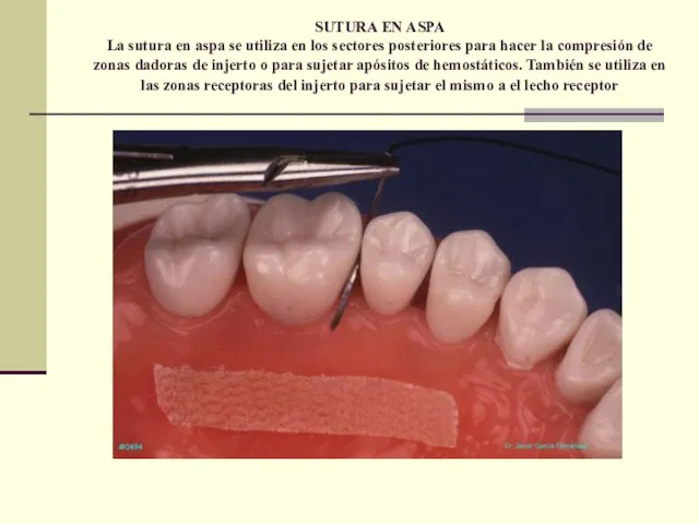 SUTURA EN ASPA La sutura en aspa se utiliza en los sectores