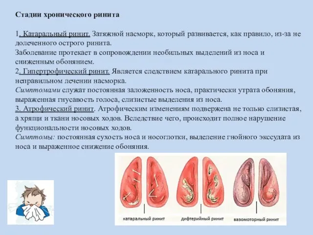 Стадии хронического ринита 1. Катаральный ринит. Затяжной насморк, который развивается, как правило,