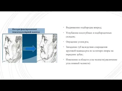Выдвижение подбородка вперед; Углубление носогубных и подбородочных складок; Опущение углов рта; Западение
