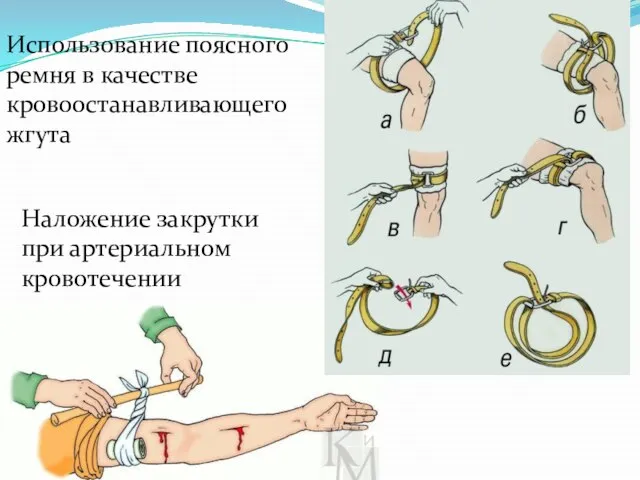 Использование поясного ремня в качестве кровоостанавливающего жгута Наложение закрутки при артериальном кровотечении