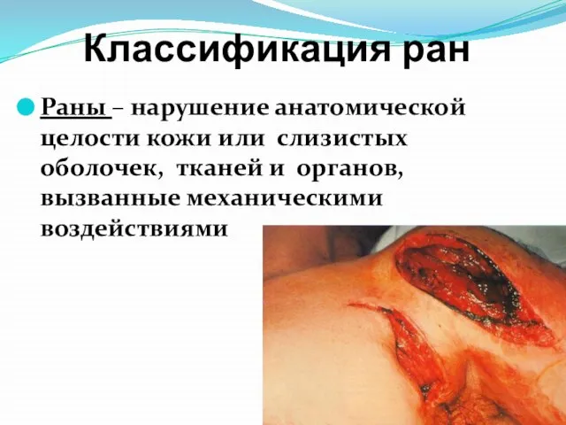 Классификация ран Раны – нарушение анатомической целости кожи или слизистых оболочек, тканей
