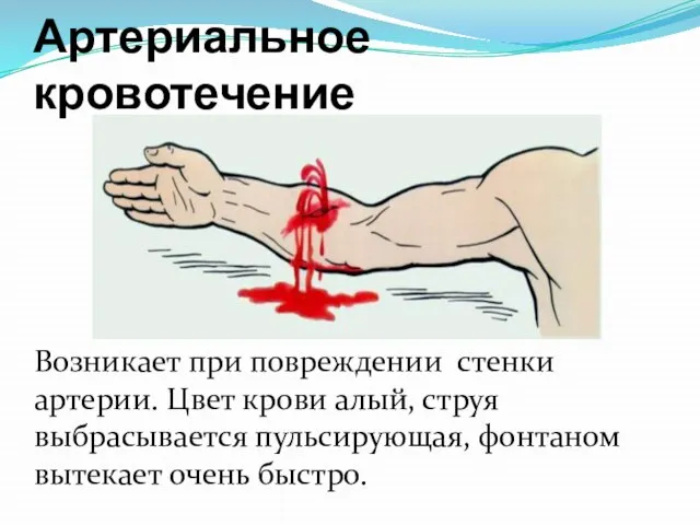 Артериальное кровотечение Возникает при повреждении стенки артерии. Цвет крови алый, струя выбрасывается