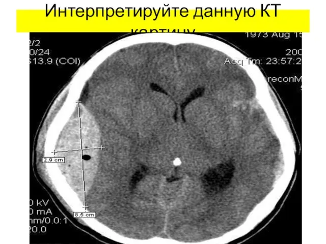 Интерпретируйте данную КТ картину