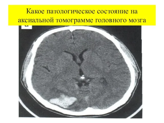 Какое патологическое состояние на аксиальной томограмме головного мозга