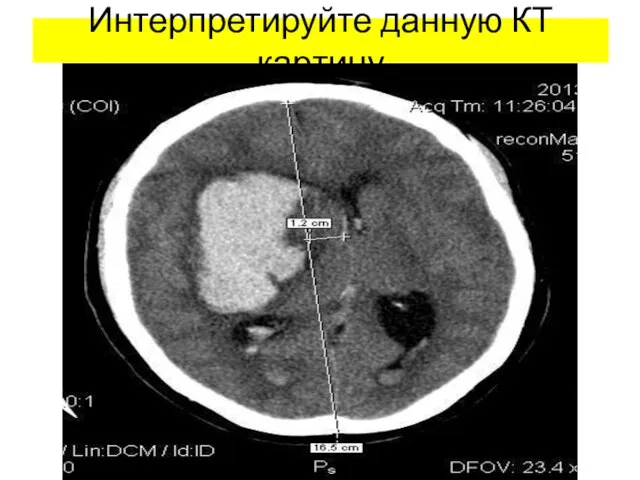 Интерпретируйте данную КТ картину