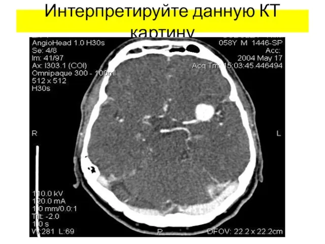 Интерпретируйте данную КТ картину