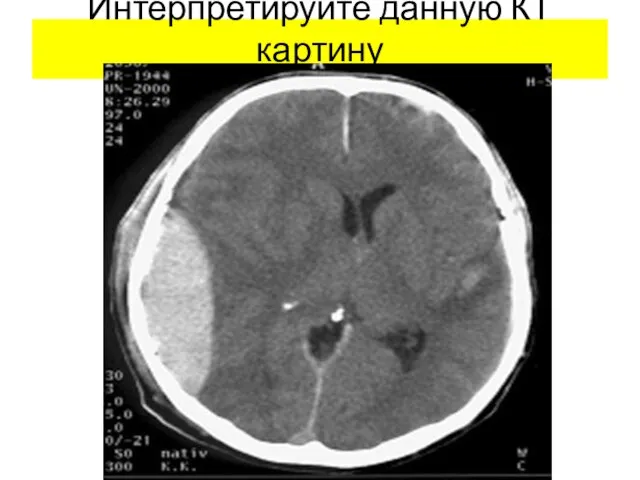 Интерпретируйте данную КТ картину