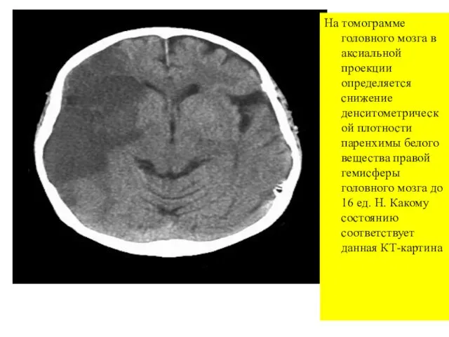На томограмме головного мозга в аксиальной проекции определяется снижение денситометрической плотности паренхимы