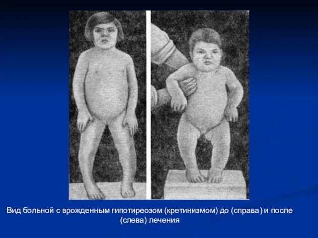 Вид больной с врожденным гипотиреозом (кретинизмом) до (справа) и после (слева) лечения