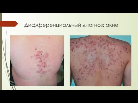 Дифференциальный диагноз: акне