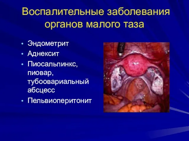Воспалительные заболевания органов малого таза Эндометрит Аднексит Пиосальпинкс, пиовар, тубоовариальный абсцесс Пельвиоперитонит