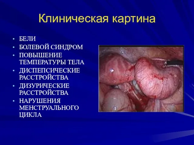 Клиническая картина БЕЛИ БОЛЕВОЙ СИНДРОМ ПОВЫШЕНИЕ ТЕМПЕРАТУРЫ ТЕЛА ДИСПЕПСИЧЕСКИЕ РАССТРОЙСТВА ДИЗУРИЧЕСКИЕ РАССТРОЙСТВА НАРУШЕНИЯ МЕНСТРУАЛЬНОГО ЦИКЛА