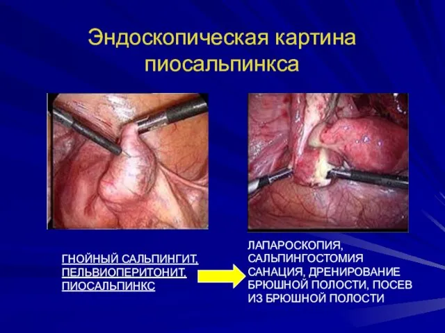 Эндоскопическая картина пиосальпинкса ГНОЙНЫЙ САЛЬПИНГИТ, ПЕЛЬВИОПЕРИТОНИТ, ПИОСАЛЬПИНКС ЛАПАРОСКОПИЯ, САЛЬПИНГОСТОМИЯ САНАЦИЯ, ДРЕНИРОВАНИЕ БРЮШНОЙ