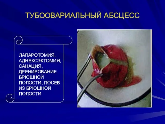 ТУБООВАРИАЛЬНЫЙ АБСЦЕСС ЛАПАРОТОМИЯ, АДНЕКСЭКТОМИЯ, САНАЦИЯ, ДРЕНИРОВАНИЕ БРЮШНОЙ ПОЛОСТИ, ПОСЕВ ИЗ БРЮШНОЙ ПОЛОСТИ