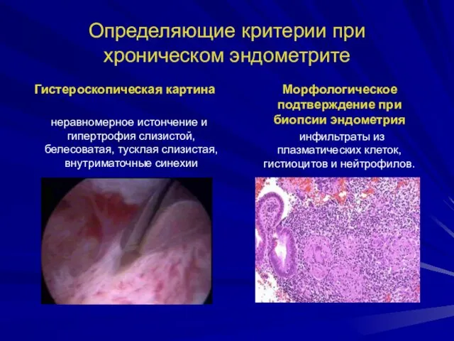 Определяющие критерии при хроническом эндометрите Гистероскопическая картина неравномерное истончение и гипертрофия слизистой,