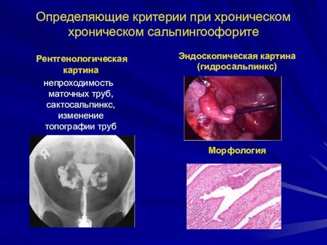 Определяющие критерии при хроническом хроническом сальпингоофорите Рентгенологическая картина непроходимость маточных труб, сактосальпинкс,