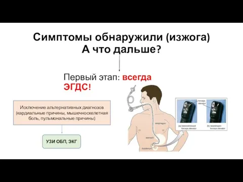 Симптомы обнаружили (изжога) А что дальше? Первый этап: всегда ЭГДС! Исключение альтернативных